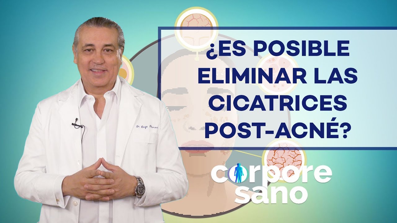agua oxigenada para cicatrices de acne