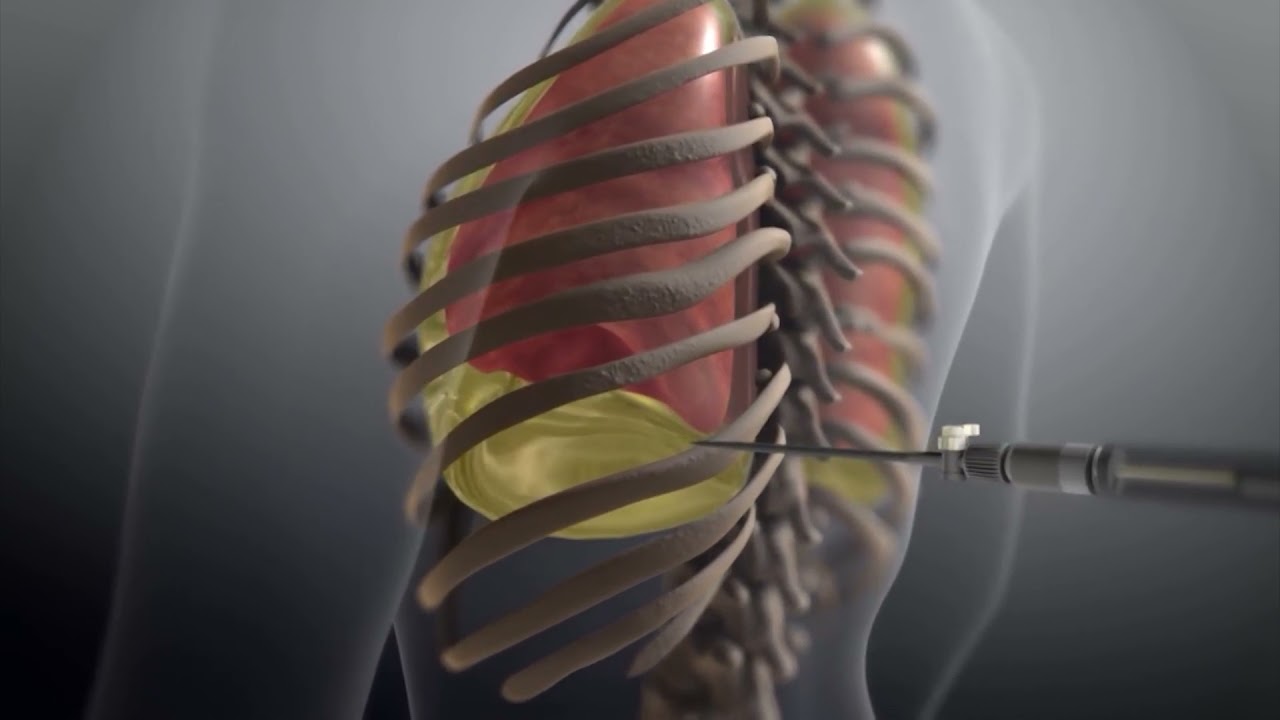 cómo se extrae el agua de los pulmones